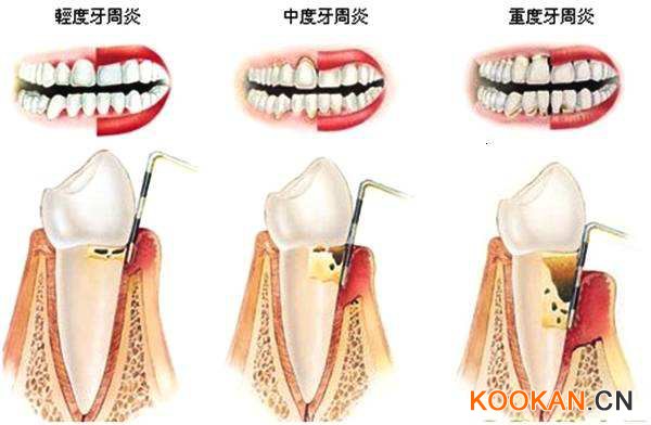 牙周炎的三個(gè)階段