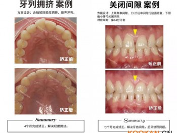 這樣的牙齒都適合用易齊微矯正