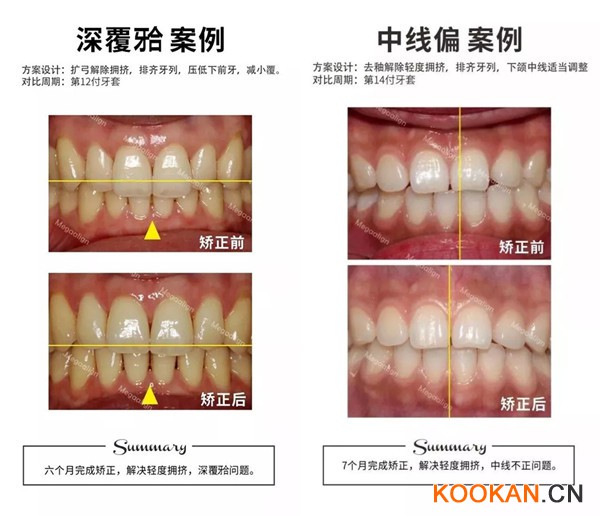 這樣的牙齒都適合用易齊微矯正