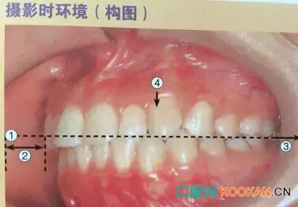 拍不好口腔照片怎么辦？這些口腔攝影方法與技巧請收好！